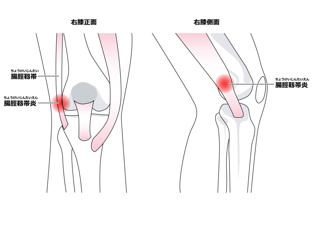 腸脛靱帯炎