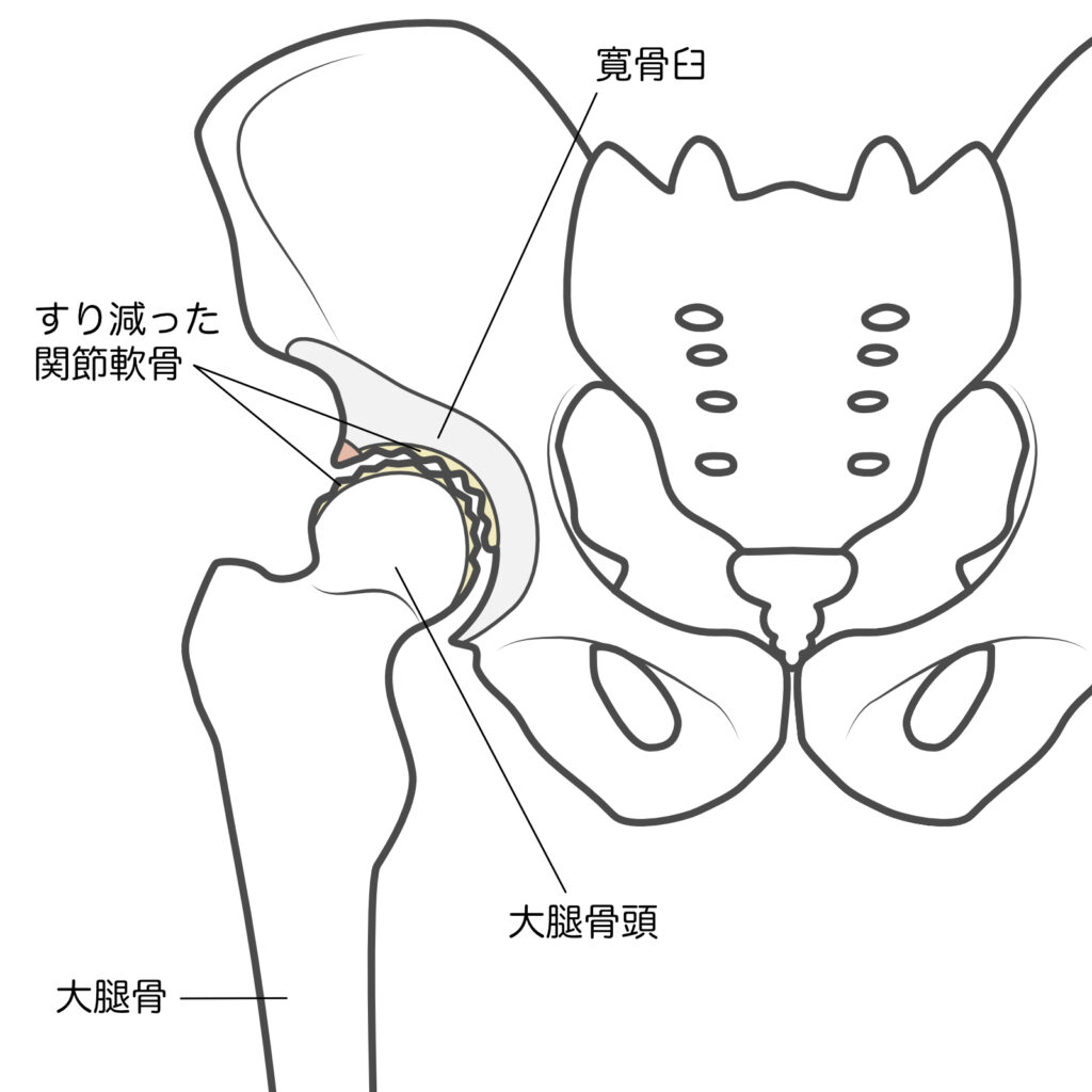 変形性股関節症の方の股関節