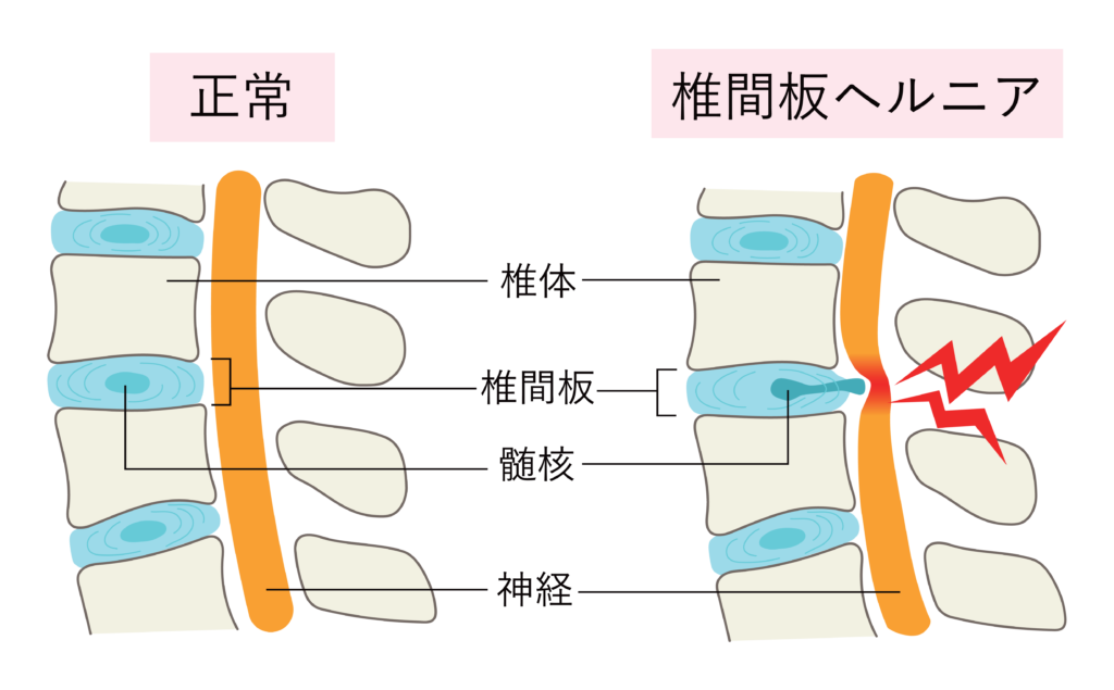 椎間板ヘルニア