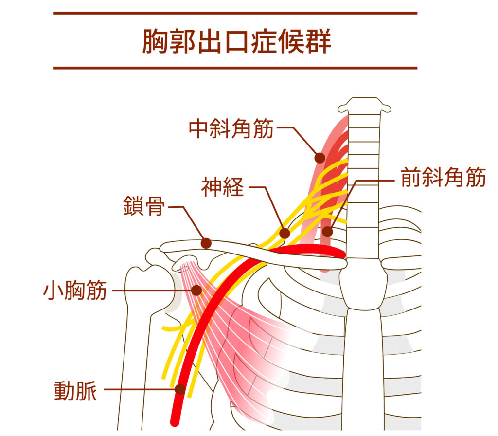 胸郭出口症候群
