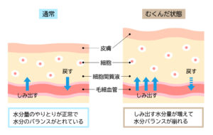 むくみ